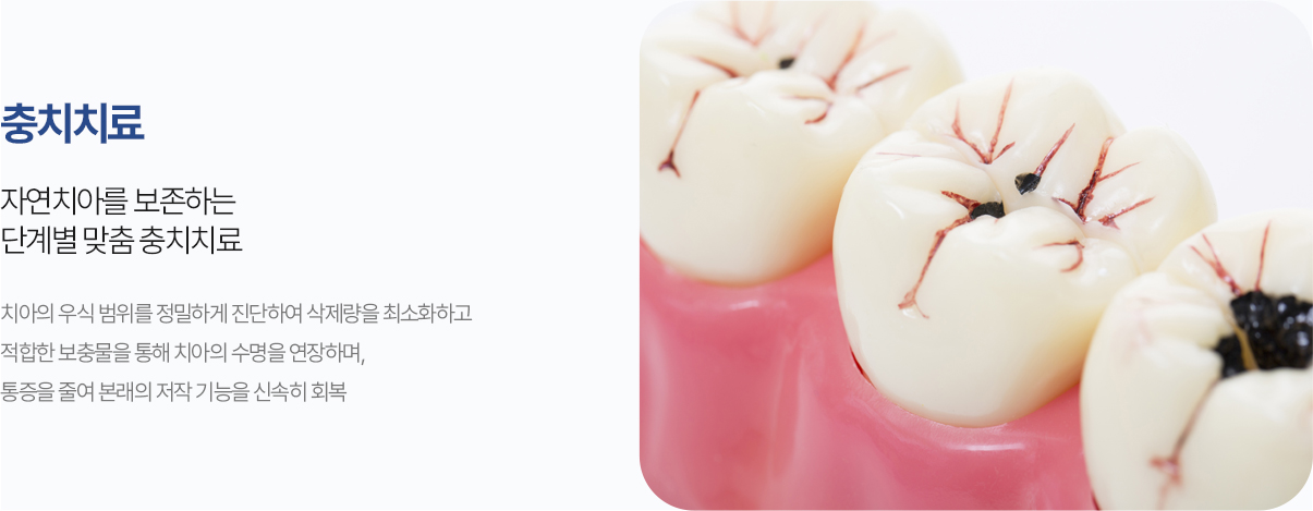 충치치료